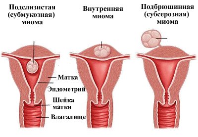 Локализация миомы матки